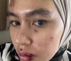 Penyebab Ruam dan Lepuh pada Wajah Kartika Putri Akhirnya Terungkap