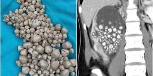 Dokter Taiwan Keluarkan 300 Batu Ginjal dari Pasien yang Suka Minuman Boba