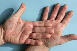 Sampel Dikirim ke Jakarta, Diskes Riau Sebut Belum Pernah Ditemukan Kasus Cacar Monyet di Riau