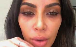 Berikut Tips Menghilangkan Lingkaran Hitam Mata, Dicoba Yuk!