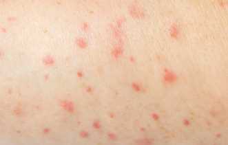 5 Cara Mencegah Jerawat