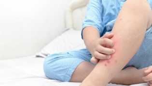 Memahami Beda Gatal Biasa dan Gatal Diabetes yang Perlu Diwaspadai