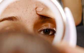 Berikut 5 Tips Hilangkan Beruntusan di Jidat yang Membandel