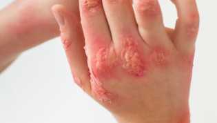 Ciri-Ciri Jantung Bermasalah Terlihat dari Kulit